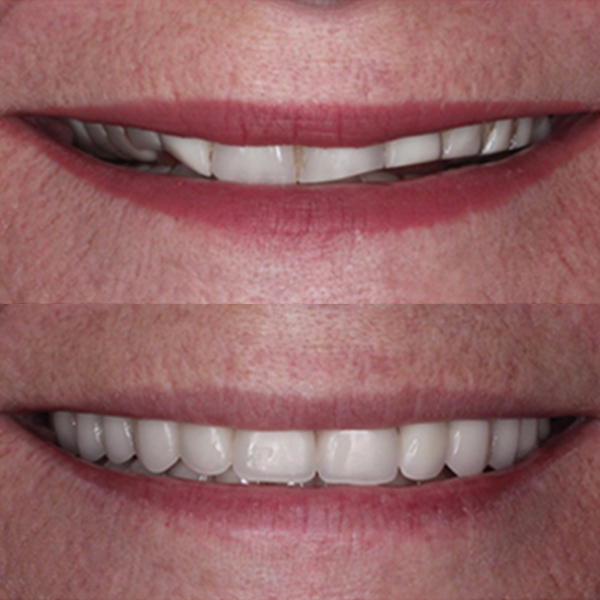 Antes e Depois Implante Dentários 1
