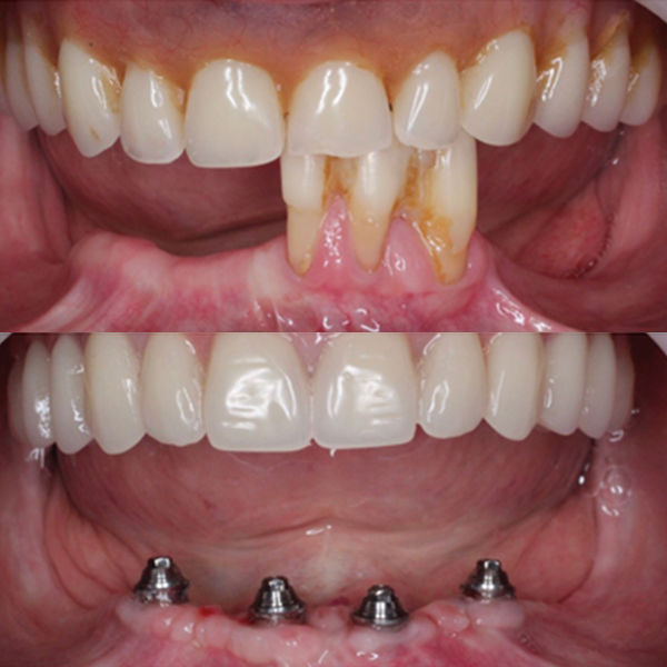 Antes e Depois Implante Dentários 2