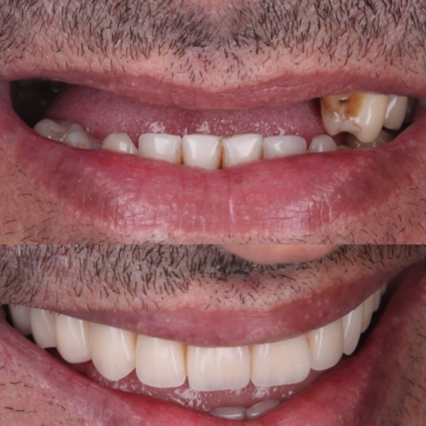Antes e Depois Implante Dentários